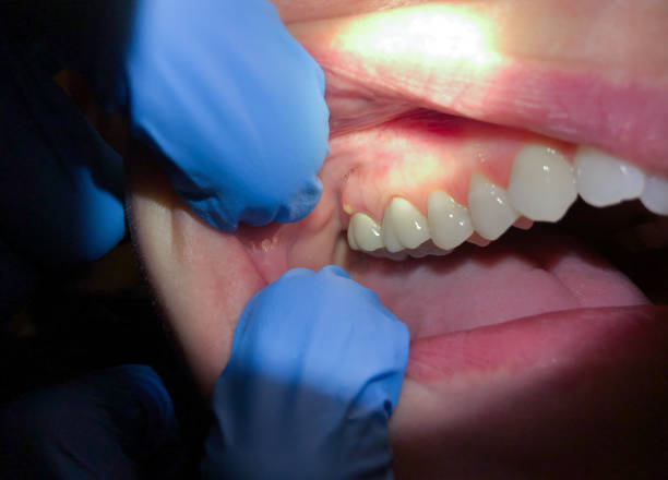 Best Emergency Root Canal Treatment in University Park, TX