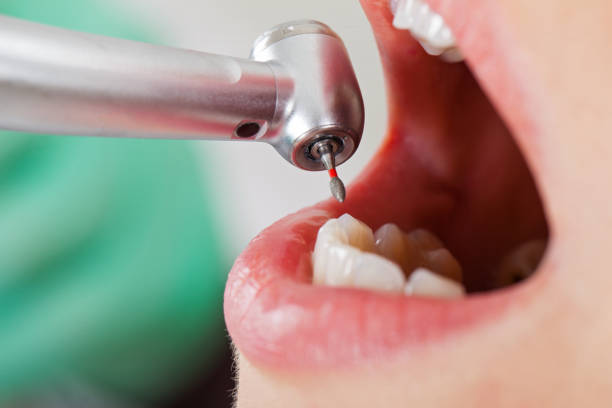 Best Emergency Dental Care for Abscessed Tooth in University Park, TX